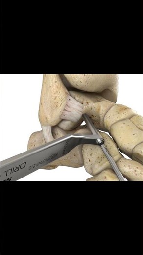 POV You need a Brostrom ATFL Repair Animation #pulse3dmedia #anatomy #3dmedicalanimation