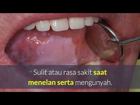 Ciri Kanker Mulut dan Tenggorokan - Gejala dan Penyebab Kanker Mulut dan Tenggorokan