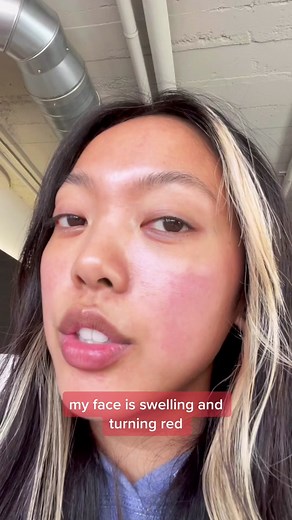 Dealing with Food Allergies: My Almond Sensitivity Story