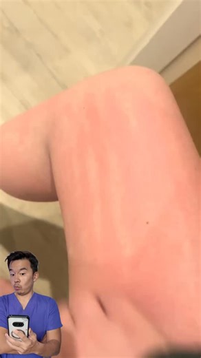 Dr Lim Ing Kien | Dermatology on Instagram: "Hives (urticaria) are very common and most often caused by allergies, infections, stress, or medications . In rare cases, persistent or unusual hives can be linked to underlying medical conditions — including blood disorders like lymphoma. Important reminder 👇 • Most people with hives do NOT have cancer • Don’t self-diagnose or panic • If hives are recurrent, unexplained, or not improving , get checked Seeing a dermatologist (and further tests if nee