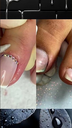 Extreme Toenail Cleaning | Relaxing ASMR #nailcleaning #asmr #callusremoval #footcare#satisfying