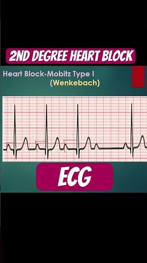 2nd degree heart block ECG l Medical Nerd #ecg #ecginterpretation #heartblock