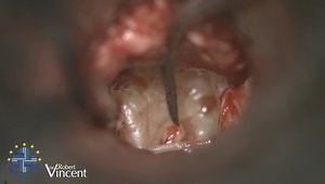 Tympanoplasty for Eroded Incus: Total Ossicular Chain Reconstruction with TM Grafting