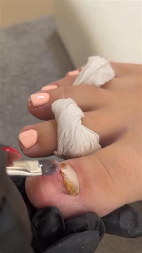 Ingrown Toenail Removal Procedure