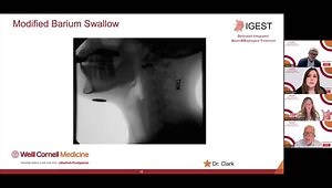 Laryngopharyngeal Reflux: Understanding Chronic Symptoms and Management