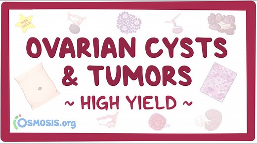 Ovarian cysts and tumors: Pathology review: Video, Causes, & Meaning | Osmosis