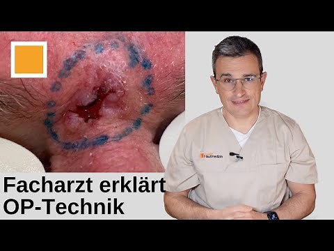 Basaliom an der Stirn entfernen, Facharzt erklärt OP-Technik. Dr. Kasten Hautmedizin in Mainz