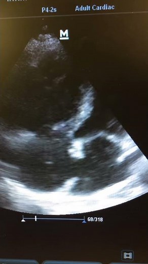 Bubble study demonstrating PFO