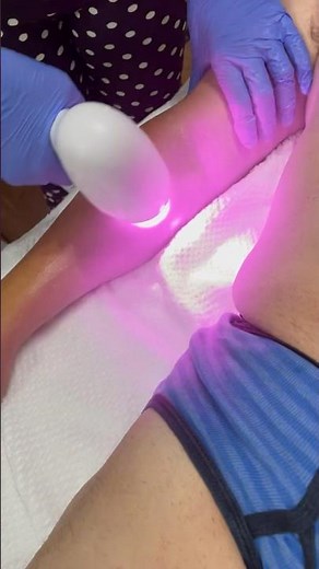 Laser Hair Removal for Men (Full Body) : Most Common Areas