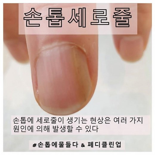 손톱세로줄 관리&예방 #손톱에물들다 #경산네일 #nails #손톱세로줄 #손톱울퉁불퉁 #손톱갈라짐 #손톱가로줄 #손톱물어뜯기 #내성손톱 #손톱멍 #손톱깨짐 #문제성손발톱 #이슈