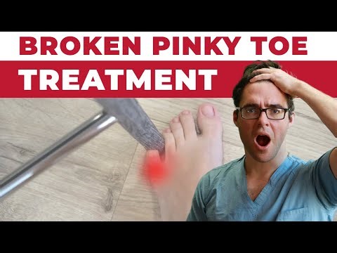 BROKEN Pinky Toe FIX [How To Tape It The Right Way]