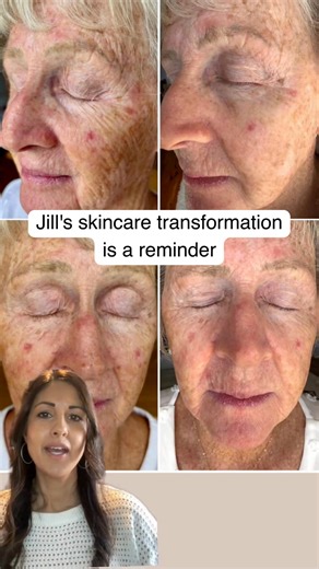 Real results. Real women. Real skin. 💚 Jill’s 8-week transformation is proof that change is possible — at any age 💫 After using our Hydrating Rich Cream Cleanser, Restorative Anti-Ageing Cream and Miracle Marine Mask, her skin now looks: ✨ More hydrated and plump ✨ Firmer with smoother texture ✨ Brighter, with reduced pigmentation ✅ Results-driven skincare for mature skin ✅ Family owned & Australian made ✅ Clean, cruelty-free, vegan friendly ✅ Small batch for quality & freshness ✅ 30-Day Money