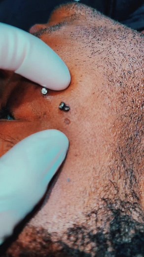 Dermal removal #dermal #removal #piercing