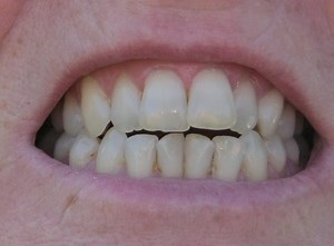 Does Regenerate Toothpaste Really Work to Rebuild Enamel and Repair Tooth Enamel Erosion