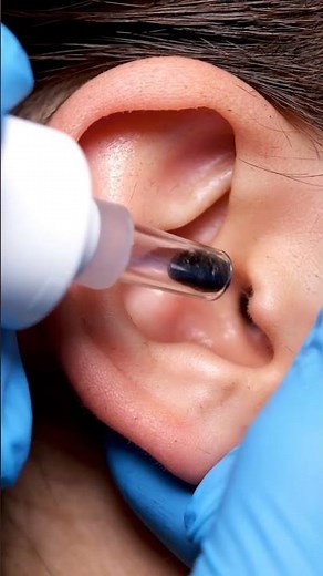 Professional Outer Ear Blackhead Removal | ASMR #satisfying #blackheadcaique #viral #foryou #fyp