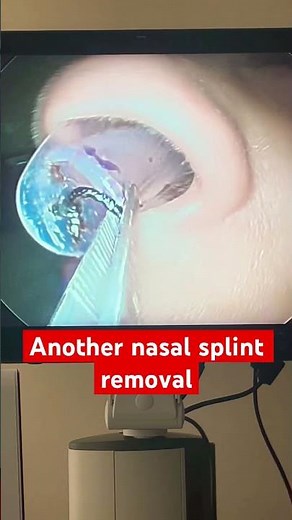 Post septoplasty splint removal. Finally breathing!