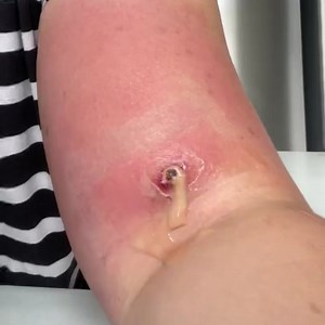 Viral Watch Pimple Pop Tv on Instagram: "Infected cyst drainage 冷 ) - : #pimple #pores #pimpletreatment # #pimplepoppers #pimples #pimplepopping #deadskin #exfoliation #oilyskin #acne #acnetreatment #acneproblems #blackheads #pimplepopper #pimplepoppingaddicts #pimplepoppersunite #newyork #pimplepoppersanonymous #pimplepoppervids #pimplepoppingvideos #pimplepops #pimplepoppin #pimplepoppertools"