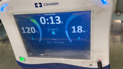 🔸請調高音量，可以聽到林醫師與患者對話🔸 最新一代的射頻電燒導管（ClosureFast™, Medtronic），可同時監測導管前端溫度與血管電阻，讓電燒溫度維持在120°C，加熱穩定且均勻，術後疼痛感較低、恢復快。 精準施打大量的腫脹麻醉液，將隱靜脈與周圍肌肉組織、皮膚、隱神經徹底隔離；大量麻醉液不僅能吸收電燒熱能、阻絕熱能對周圍組織的傷害。 同時，局部麻醉下，患者意識完全清醒，如有任何部位腫脹麻醉藥施打不完全，熱傷害到周圍肌肉組織或神經，都能馬上察覺而彌補施打，即時避免可能的併發症與風險。（如果是採全身麻醉或半身麻醉，就等術後麻醉退了才曉得…） | 靜脈曲張 微創治療 林哲安醫師