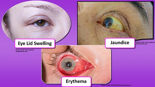 How to Assess the Eyes (Nursing)