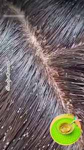 ✅ Remove Lice Instantly/ Lice Removal Shampoo Hack #shorts #haircare #hairwash #lice #liceremover #shampoo #youtubeshorts #fbreelsfypシ゚viralシ #fbreelsfypシ゚ #fbreelsfypシ゚viralfbreelsfypシ゚viral #fbreelsvideo #fbreels #fbreels2025ツ #fbreelsfypシ゚viralfbreelsfypシ゚viral2025 #reelsfacebook #exploremore #explorepage #beautywihsunanda #reelsfbシviralシ #fbpost2025シ #viralreelsシ #foryoupageシforyou #viralreelsfacebook #viralreelschallenge #foryoupageシ | Beauty With Sunanda