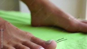 Therapist performing moxibustion and acupuncture procedure at health center. Moxibustion is a thermal effect on biologically active points located across the entire surface of the human body.