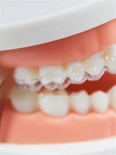 🔹 Ligatures are a key element for arch control and biomechanical management in lingual orthodontics. Choosing between elastic ligatures, metal ligatures, or options such as the Overtie makes it possible to modulate forces, reduce friction, and enhance the precision of tooth movement. Proper placement helps protect oral tissues, improve patient comfort, and increase overall treatment efficiency. 👉 Strengthen your clinical judgment in lingual orthodontics with the Master’s Degree in Orthodontics