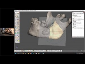 Webinar: Redefining patient specific 3D design with Geomagic Freeform