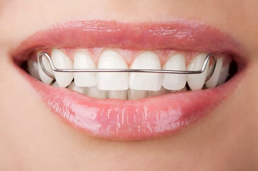 Orthodontic Appliances