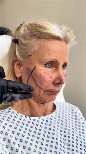 14K views · 58 reactions | Shocking Transformation: 65-Year-Old Woman Looks 35 After Bold Surgery – You Won’t Believe Her New Face Check in comments⬇️ | Best Articles | Facebook