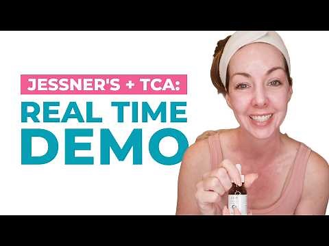 Watch Me Peel: Step-by-Step Jessner’s + 13% TCA Layering