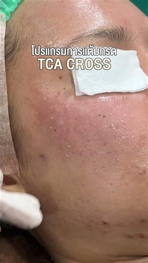 โปรแกรม Combo Smart RF #หลุมสิว #รักษาหลุมสิว