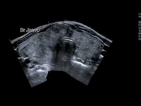 Huge multinodular goiter of thyroid- ultrasound and color Doppler video: thyroid enlargement