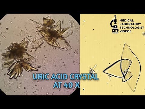 Uric Acid crystals in urine microscopy at 40X.