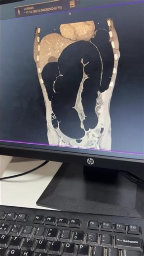 volvulus of the sigmoid