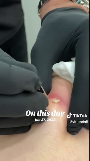 Understanding Skin Cysts: Causes and Treatments