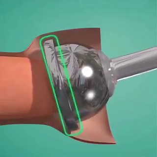 How a disposable circumcision stapler makes the procedure faster, cleaner, and with minimal bleeding.