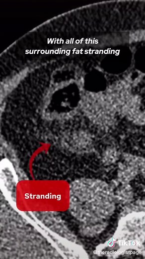 Understanding Ureteral Filling Defects in CT Imaging