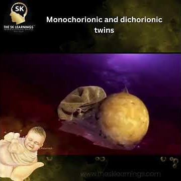 Monochorionic and dichorionic twins