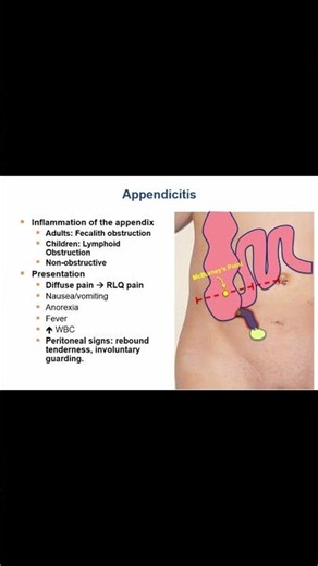 Appendicitis Explained Location, Symptoms, & Pain