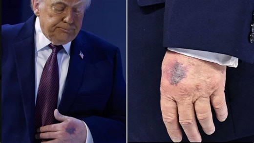 Big Blue Bruise On Trump's Hand Draws Attention At Davos, President Blames This Medicine