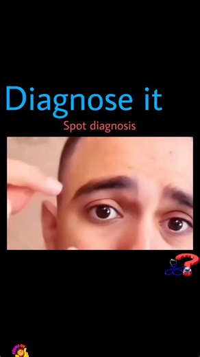 Dr Harsh Duhan on Instagram: "🩺 Test Your Diagnostic Skills! 🔍 Think you can crack today’s case? Drop your guess below ⬇️ 💬 Comment "Details" to get the complete answer delivered straight to your inbox! 📚 Want 178+ real clinical cases with explanations? Grab our Case Series eBook—perfect for NEET PG, INICET, USMLE & more! DM @diagnose_it to get yours. 🚨 Giveaway Alert! Share this post in your stories + tag us for a chance to WIN a free Case Series eBook! 🎉 👥 Tag your smartest friend and s