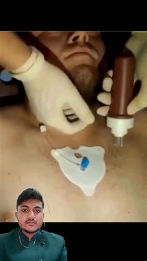 Yogesh Medicare YT on Instagram: "Intraosseous access #emergency #ivalternative"