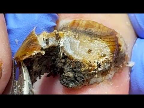 Toenails Are Like A Mountain Of Weeds And Dirt!【Xue Yidao】