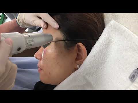 Birthmark Removal (Port Wine Stains) at Laser Skin Care