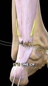 78K views · 522 reactions | Torn Achilles Tendon Repair (3D Animation) #tornachilles #Achilles #achillesrecovery #tendon #achillestendon #medical3danimation #3dmedicalanimation | Medcare777 | Facebook