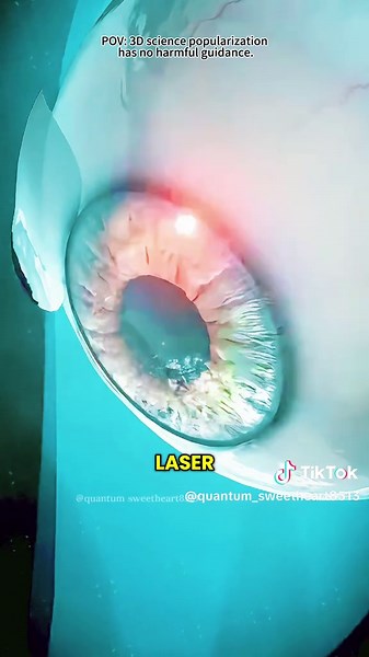 How Lasik Eye Surgery Is Performed (3D Animation) #medical3danimation #3dmedicalanimation #eyesurgery #visioncorrection #lasersurgery