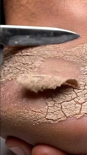 Satisfying Foot Cleaning | Dry Heel Renewal