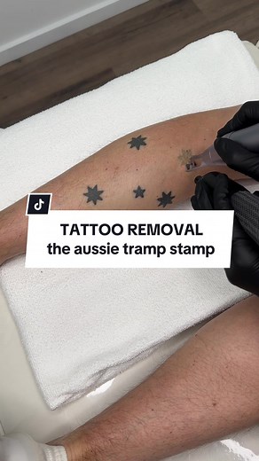 The Aussie tramp stamp 🇦🇺 If you have one, you know what we are talking about 😉 These tattoos are what we refer to as a “trend” tattoo. A specific design that was so popular and thousands of people had similar designs tattooed. Years later, we find that many of those people look at having the tattoo removed as it no longer suits their style or what they want tattooed on their bodies. Do you have a trend tattoo? #tattooremoval #trendtattoos #tattooregret #adelaidetattooremoval #freshstart #aus