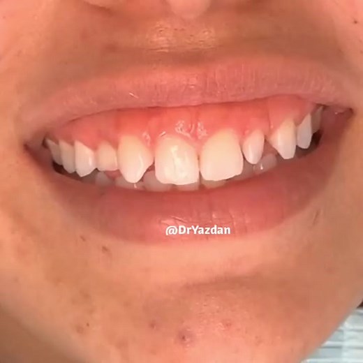 Wax Up Try-In Process for Smile Makeover | Dental Procedures Explained