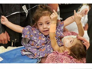 Conjoined Twins Undergo Successful Separation Surgery At Stanford Hospital